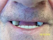 Smile Gallery Photo: Before Treatment