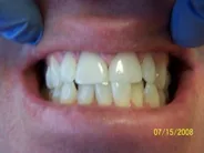 Smile Gallery Photo: After Treatment