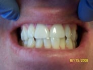 Smile Gallery Photo: After Treatment