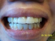 Smile Gallery Photo: After Treatment