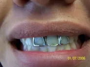 Smile Gallery Photo: Before Treatment
