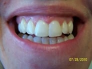 Smile Gallery Photo: After Treatment