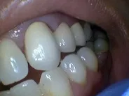 Smile Gallery Photo: After Treatment