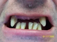 Smile Gallery Photo: Before Treatment