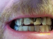 Smile Gallery Photo: Before Treatment