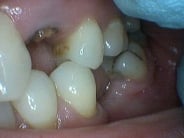 Smile Gallery Photo: Before Treatment