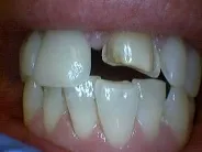 Smile Gallery Photo: Before Treatment