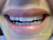 Smile Gallery Photo: After Treatment