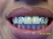 Smile Gallery Photo: Before Treatment