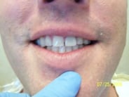 Smile Gallery Photo: After Treatment