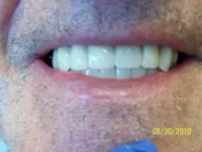 Smile Gallery Photo: After Treatment