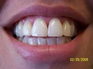 Smile Gallery Photo: After Treatment