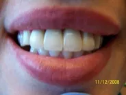Smile Gallery Photo: After Treatment