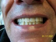 Smile Gallery Photo: After Treatment