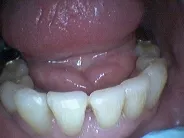 Smile Gallery Photo: After Treatment