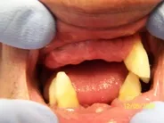 Smile Gallery Photo: Before Treatment