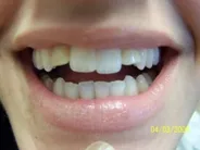Smile Gallery Photo: Before Treatment
