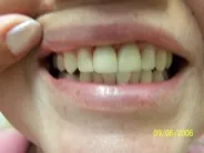 Smile Gallery Photo: After Treatment