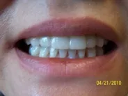 Smile Gallery Photo: After Treatment