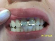 Smile Gallery Photo: Before Treatment