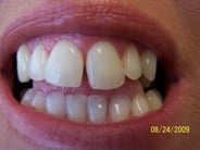 Smile Gallery Photo: Before Treatment