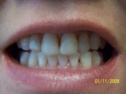 Smile Gallery Photo: Before Treatment