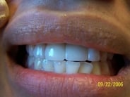 Smile Gallery Photo: After Treatment
