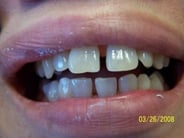Smile Gallery Photo: Before Treatment