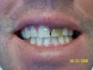 Smile Gallery Photo: Before Treatment