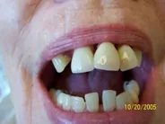 Smile Gallery Photo: Before Treatment
