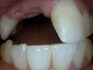 Smile Gallery Photo: Before Treatment
