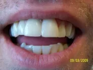 Smile Gallery Photo: After Treatment