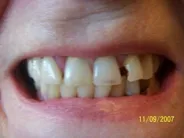 Smile Gallery Photo: Before Treatment