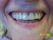 Smile Gallery Photo: After Treatment