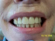 Smile Gallery Photo: After Treatment