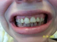 Smile Gallery Photo: Before Treatment