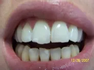 Smile Gallery Photo: Before Treatment