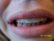 Smile Gallery Photo: After Treatment