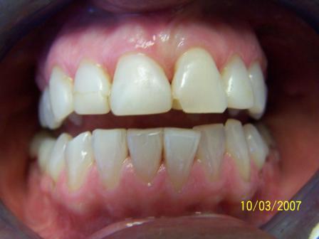 Smile Gallery Photo: Before Treatment