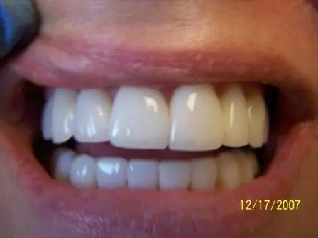 Smile Gallery Photo: After Treatment