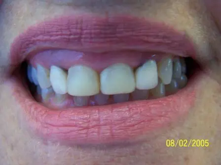 Smile Gallery Photo: Before Treatment