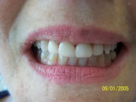 Smile Gallery Photo: After Treatment